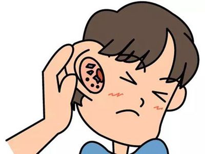  外耳道炎的治疗与预防
